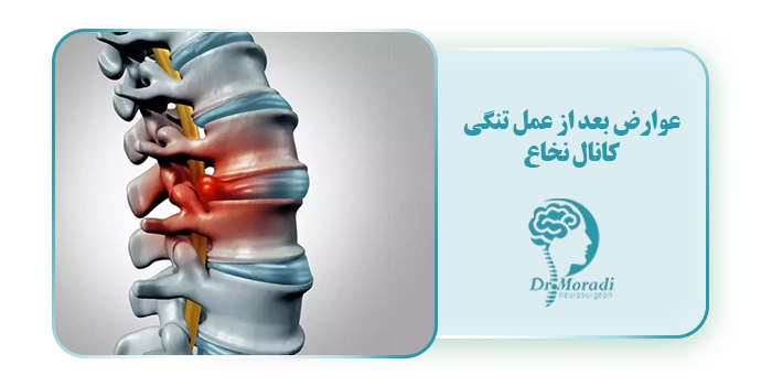 عوارض بعد از عمل تنگی ‌کانال نخاع؛ راه‌های کاهش و پیشگیری