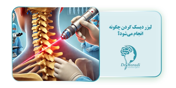 لیزر دیسک گردن چگونه انجام می‌شود؟