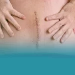 مراقبت های بعد از عمل تنگی کانال نخاع