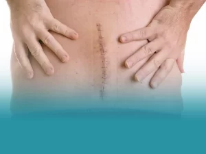 مراقبت های بعد از عمل تنگی کانال نخاع