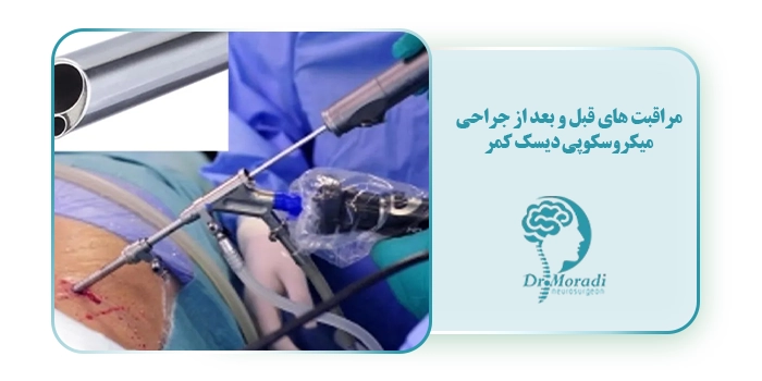 مراقبت های قبل و بعد از جراحی میکروسکوپی دیسک کمر