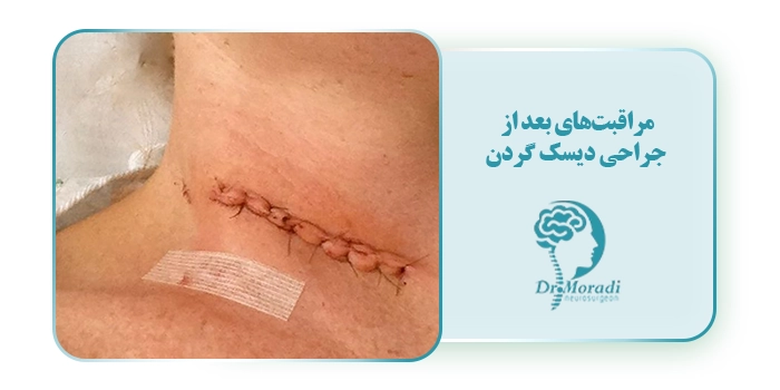 مراقبت‌های بعد از جراحی دیسک گردن