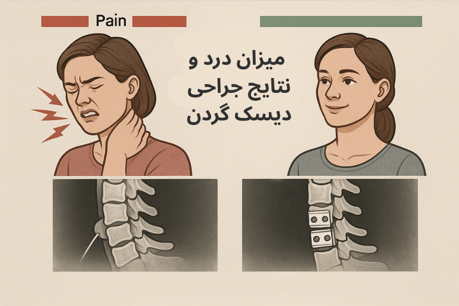 میزان درد و نتایج جراحی دیسک گردن