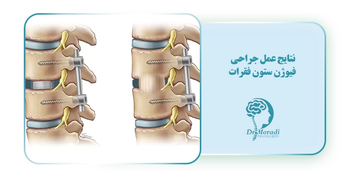 نتایج عمل جراحی فیوژن ستون فقرات