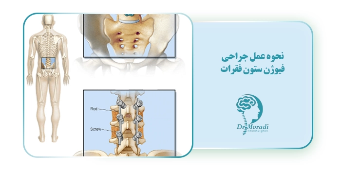 نحوه عمل جراحی فیوژن ستون فقرات