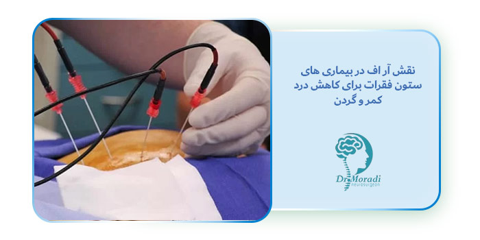 نقش آر اف در بیماری های ستون فقرات برای کاهش درد کمر و گردن