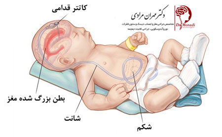 شانت مغزی