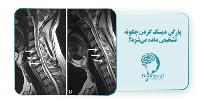 پارگی دیسک گردن چگونه تشخیص داده می‌شود؟