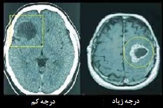 گلیوما چگونه درجه بندی می‌شود؟