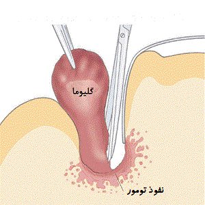 گلیوماها چگونه درمان می‌شوند؟